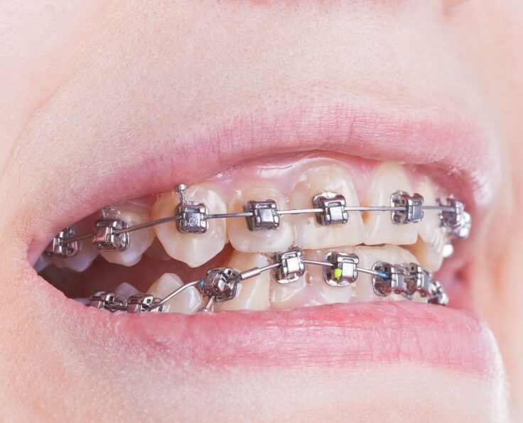 metal-braces