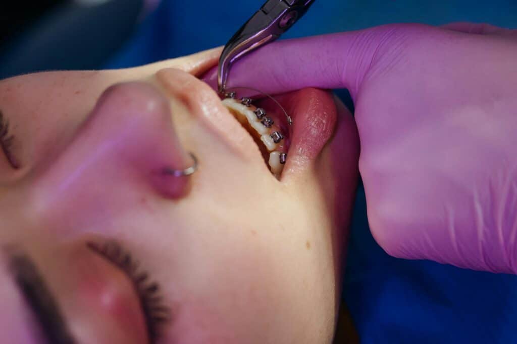 Braces treatment in West Hempstead, NY