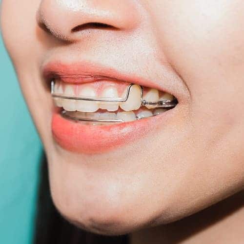 Retainer-needed