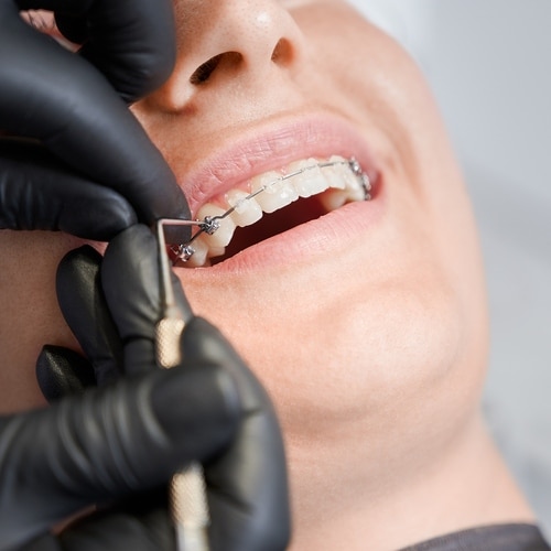 Braces in West Hempstead