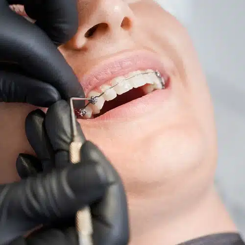 Braces in West Hempstead