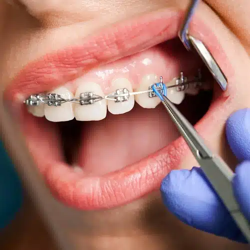 braces-placement-img