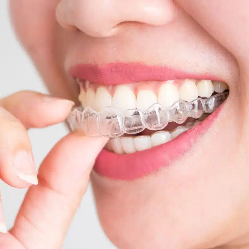 Invisalign Treatment in West Hempstead