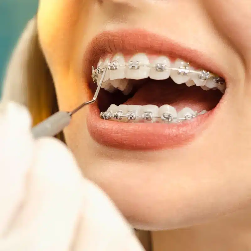 Orthodontic Braces available in West Hempstead