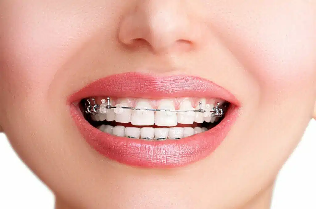 Damon Braces