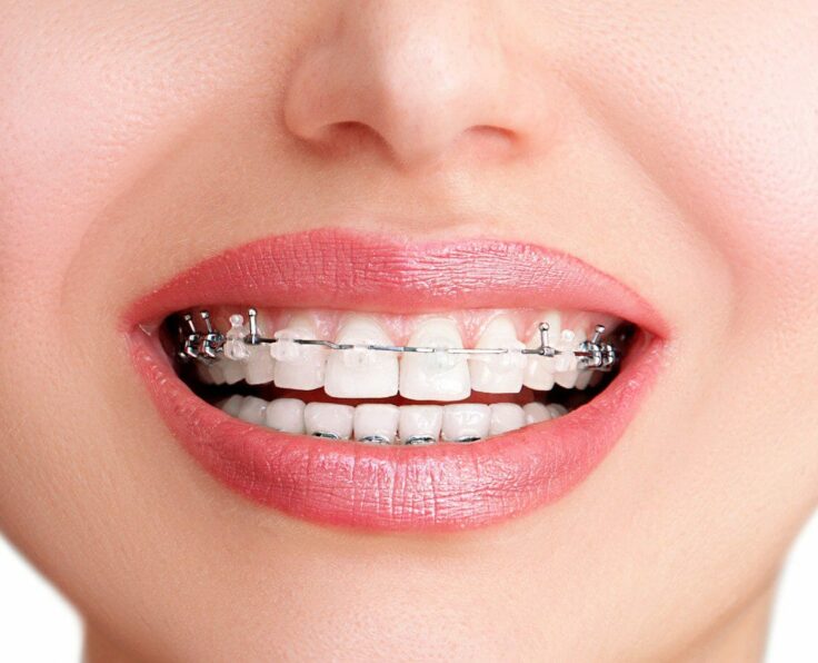 Damon Braces