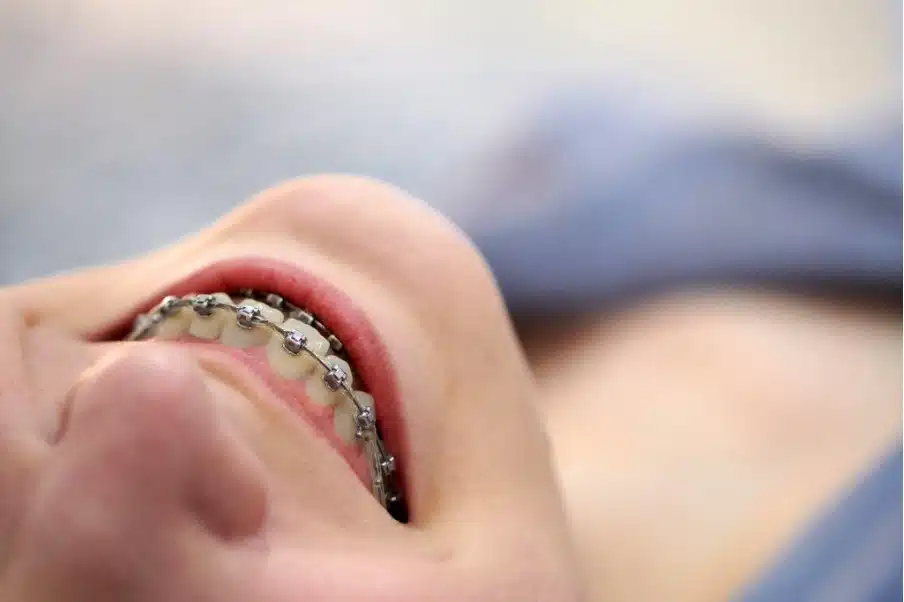 Cost of Damon braces