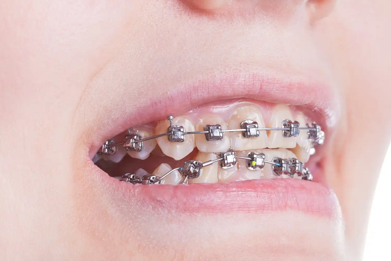 Clear Damon Braces