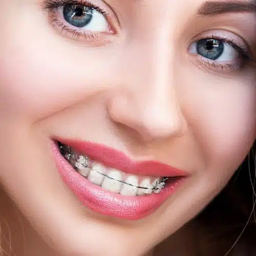 Damon Braces at Eisenberger & Bindiger
