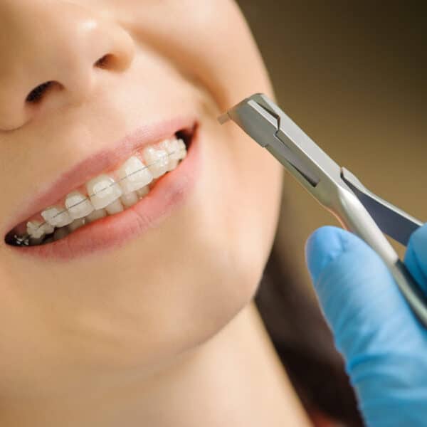 lightforcebraces-adjustments