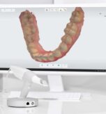 iTero Scanner in West Hempstead for Digital Smile Design