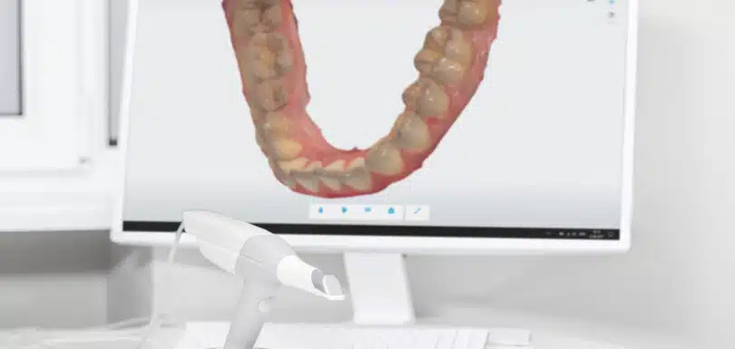 iTero Scanner in West Hempstead for Digital Smile Design