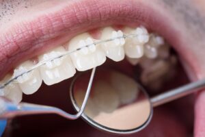 Adult Braces Options in West Hempstead