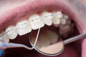Adult Braces Options in West Hempstead