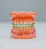 Customizing Braces in West Hempstead for Comfortable Treatment