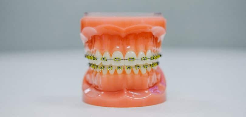 Customizing Braces in West Hempstead for Comfortable Treatment