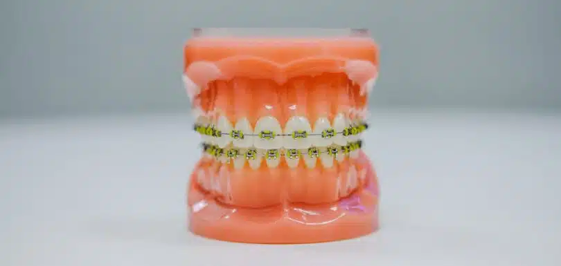 Customizing Braces in West Hempstead for Comfortable Treatment