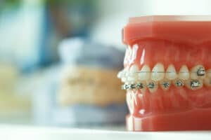 Orthodontic model showing braces used alongside cone beam technology