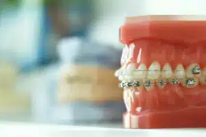 Orthodontic model showing braces used alongside cone beam technology