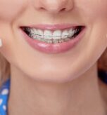 Close-up of clear LightForce Braces West Hempstead on patient’s teeth