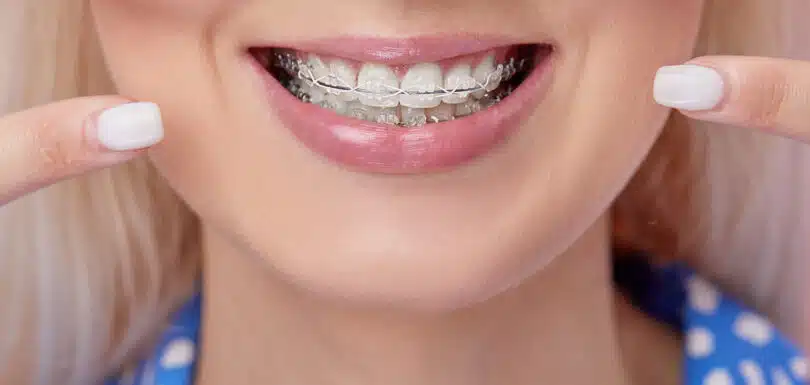 Close-up of clear LightForce Braces West Hempstead on patient’s teeth