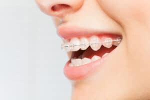 Side view showing braces comfort innovations on teeth
