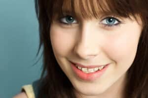 Teen smiling with custom 3D-printed braces