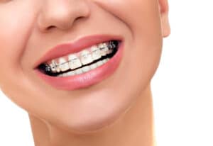 Close-up view of braces on teeth representing modern Braces West Hempstead options for improved comfort