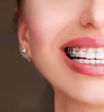 Close-up of a smile wearing clear braces highlighting Damon Braces West Hempstead and modern comfort-focused treatment