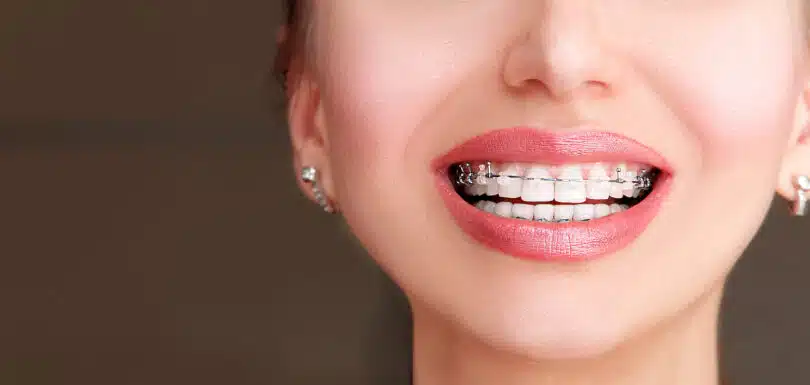 Close-up of a smile wearing clear braces highlighting Damon Braces West Hempstead and modern comfort-focused treatment