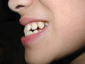 Side view of a child’s teeth showing bite concerns addressed with phase 1 orthodontic treatment