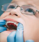 Child wearing an early orthodontic appliance during Phase 1 Treatment West Hempstead visit
