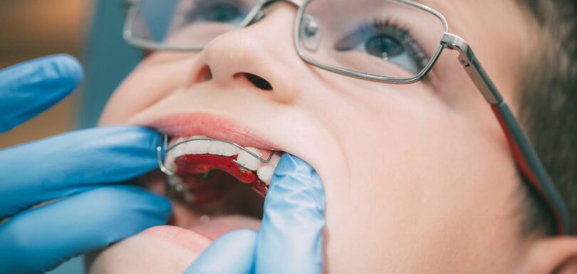Child wearing an early orthodontic appliance during Phase 1 Treatment West Hempstead visit