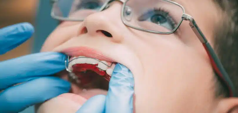 Child wearing an early orthodontic appliance during Phase 1 Treatment West Hempstead visit