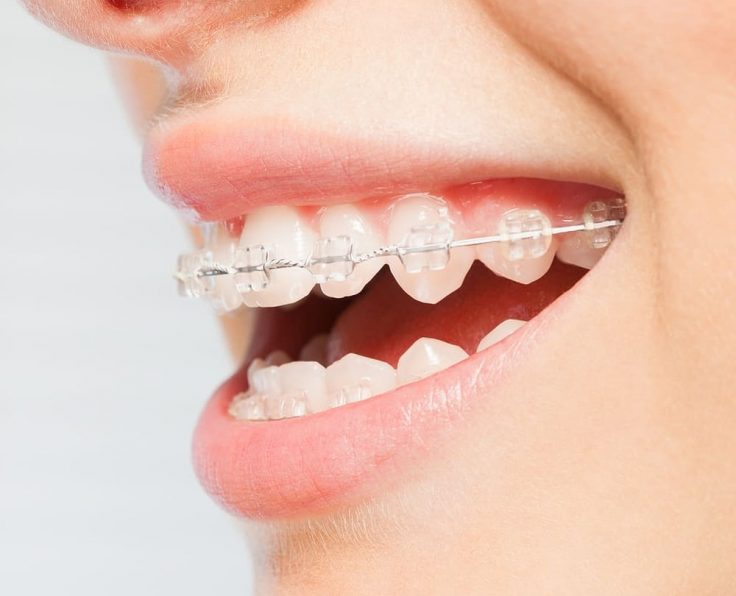 ceramic-braces