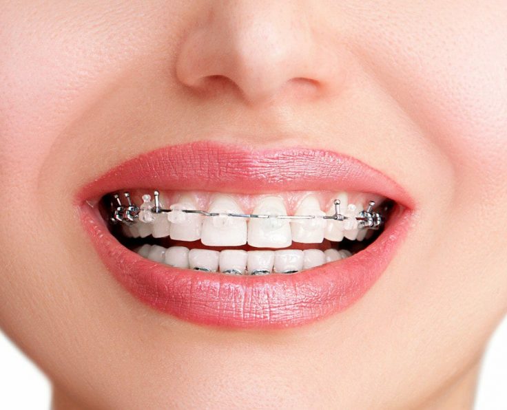 Damon Braces