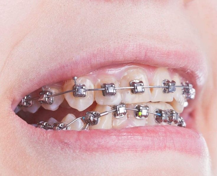 metal-braces
